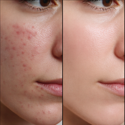 Vyrelle™ Alpha-Arbutin Brightening Hydrogel Mask (Dark Spots & Hyperpigmentation Care)